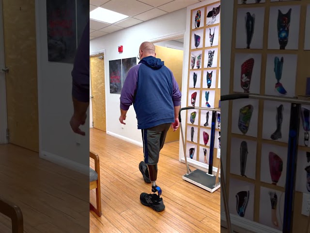 After 11 Years as an Amputee, Steve Finally Found the Right Prosthetic Fit