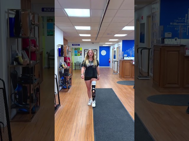Rotationplasty transformation Delany's Prosthetic Progress