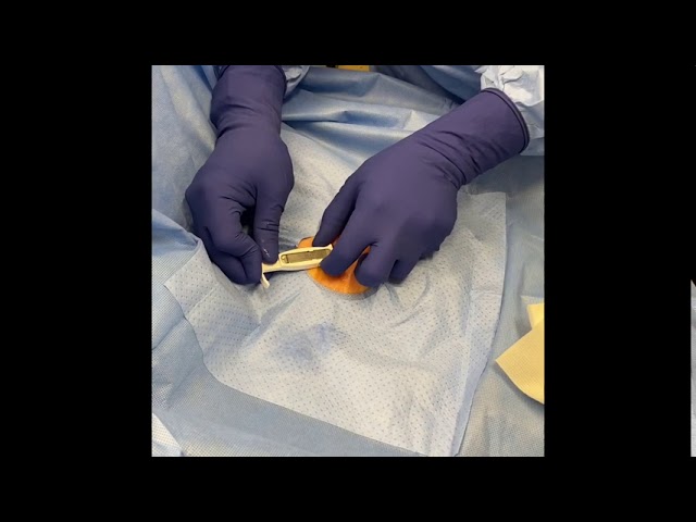 Detecting Atrial Fibrillation (AFib): Cardiac Monitor Implant Procedure