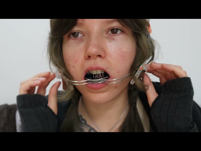 Bracesforfun Video 7 YT