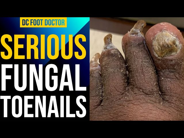 Serious Fungal Toenails: Helping Those Who Can't Help Themselves