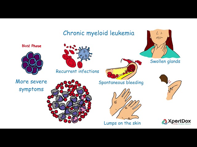What is Chronic myeloid leukemia?