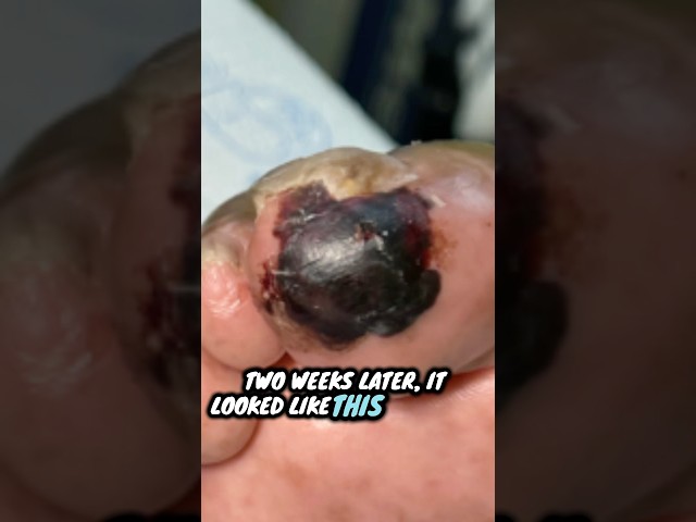 Take all diabetic foot injuries seriously #podiatry #diabetes #footinjury