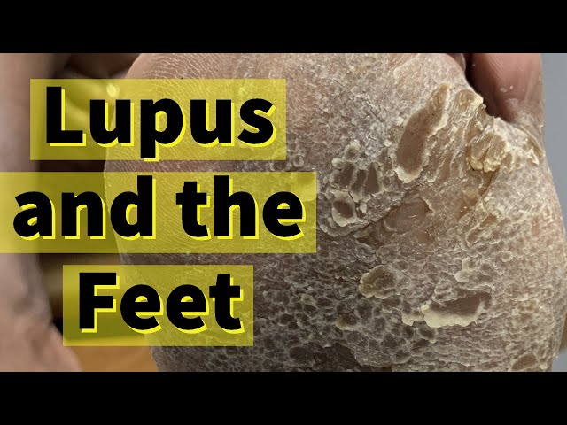 Lupus and the Feet: Severe Calluses and Dry Skin