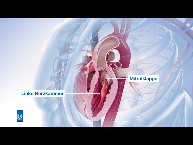 Mitral regurgitation surgery | Medical animation