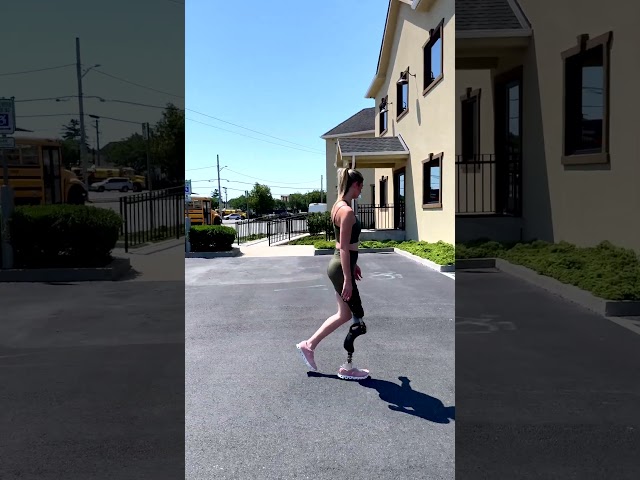 Custom Rotationplasty Prosthesis | Emily's Patient Story