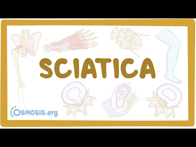 Sciatica - causes, symptoms, diagnosis, treatment, pathology