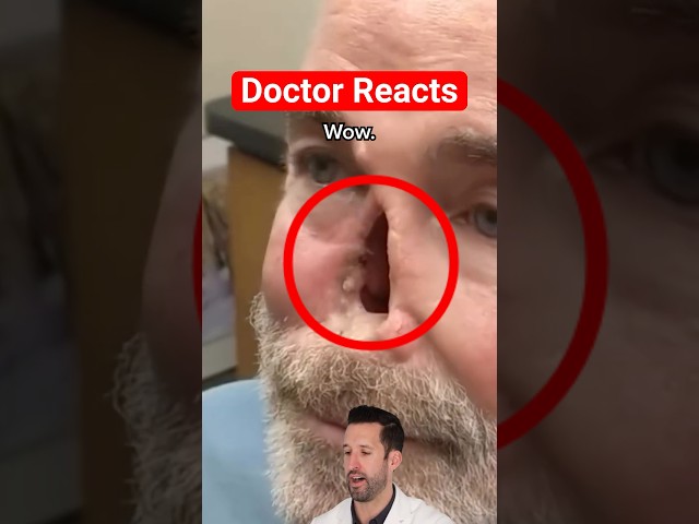 ER Doctor REACTS to World's Coolest Nasal Prosthesis