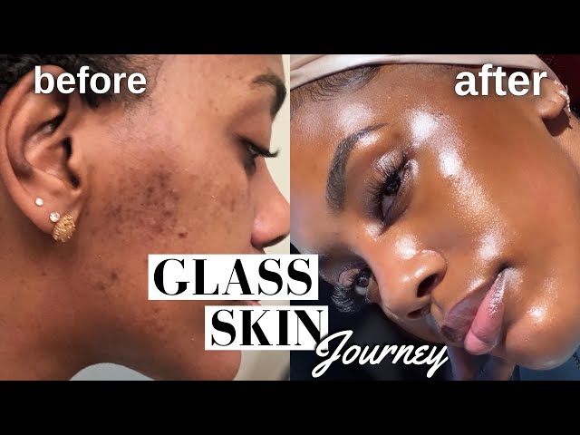 HOW I CLEARED MY HYPERPIGMENTATION, ACNE, AND DARK SPOTS!! | GLASS SKIN ROUTINE *MUST WATCH*