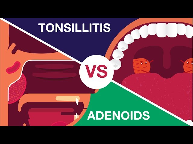 What is Adenoids and Tonsillitis? (Complete Video)