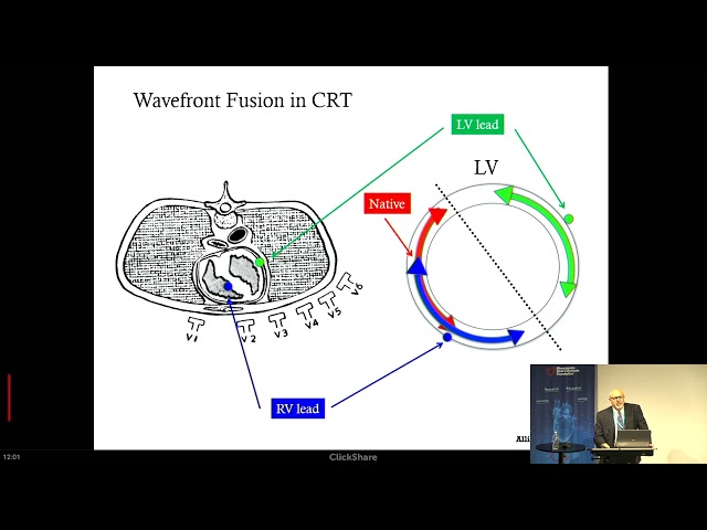 Alan Bank, MD | Electrical Dyssynchrony and Cardiac Resynchronization Therapy