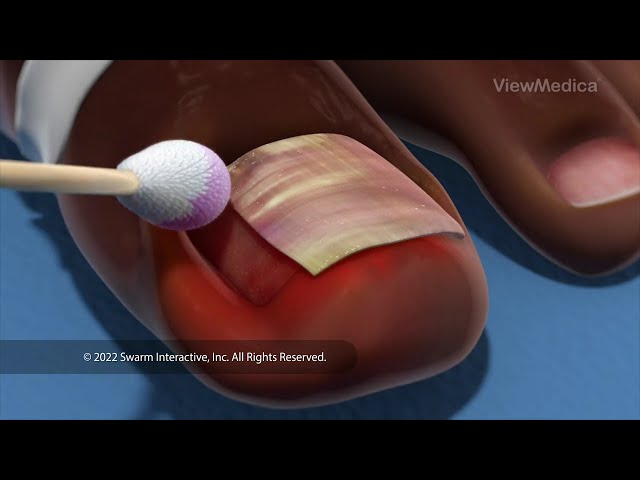 Ingrown Toenail Surgery (3D Animation)