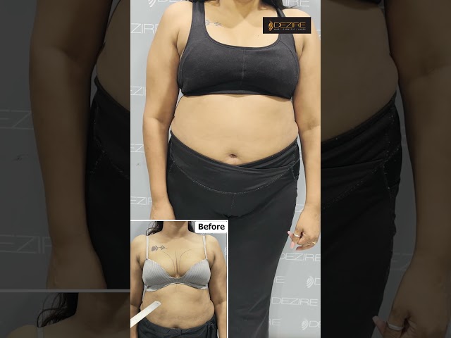 Breast Implant Feedback