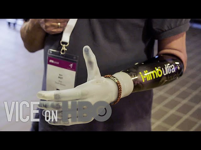 How Bionic Limbs Are Changing Lives