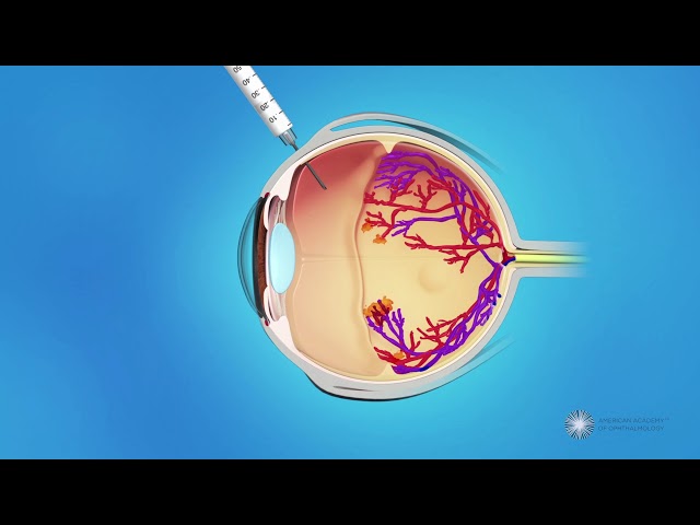 Anti-VEGF injections for ROP