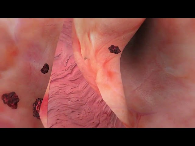 Patent Foramen Ovale Closure   Amplatzer PFO Occluder