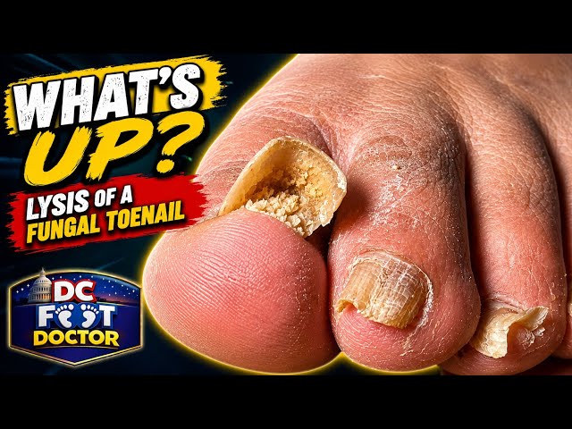 What's Up? Lysis of a Fungal Toenail