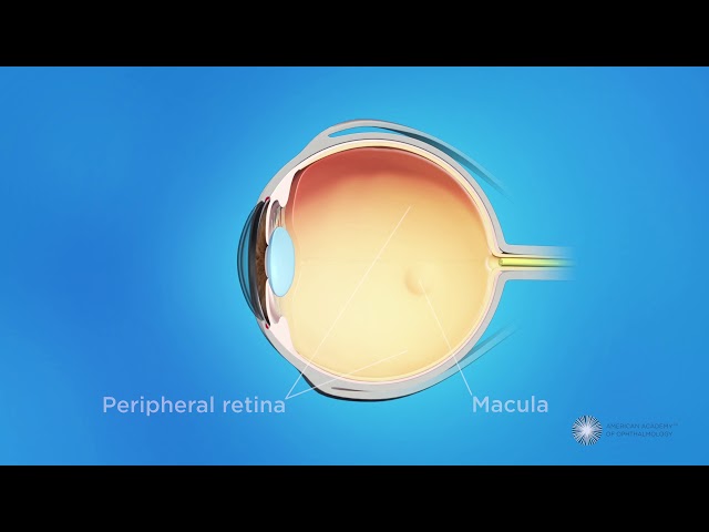 What is retinopathy of prematurity (ROP)?