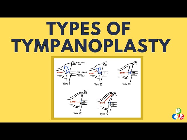 Types of Tympanoplasty with Diagrams - Wullstein Classification | ENT Made Easy