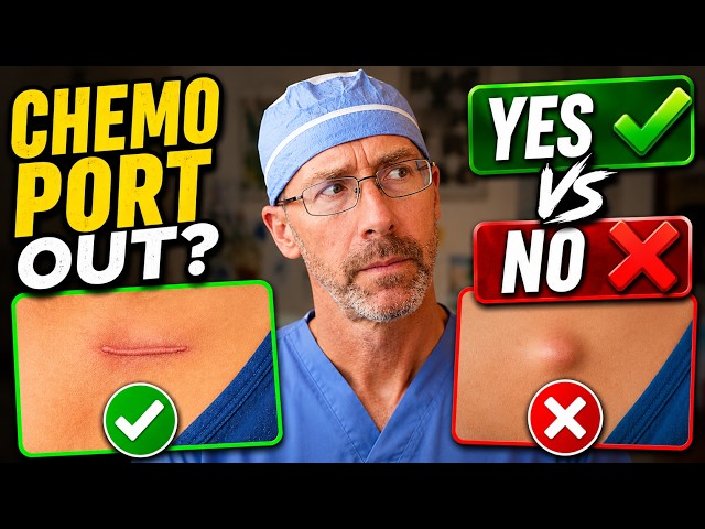 Cancer Treatment Is Over—Should Your Port Come Out?