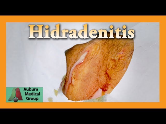 Armpit Abscess (Hidradenitis Suppurativa) | Auburn Medical Group