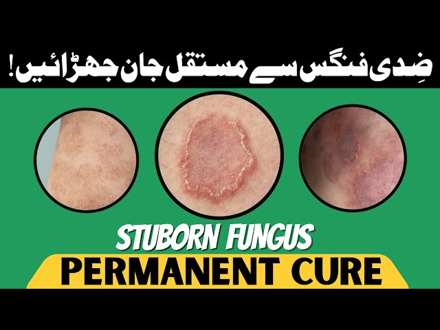 Fungus Treatment | Home Remedies for Fungus | Fungus ka gharelu Elaaj