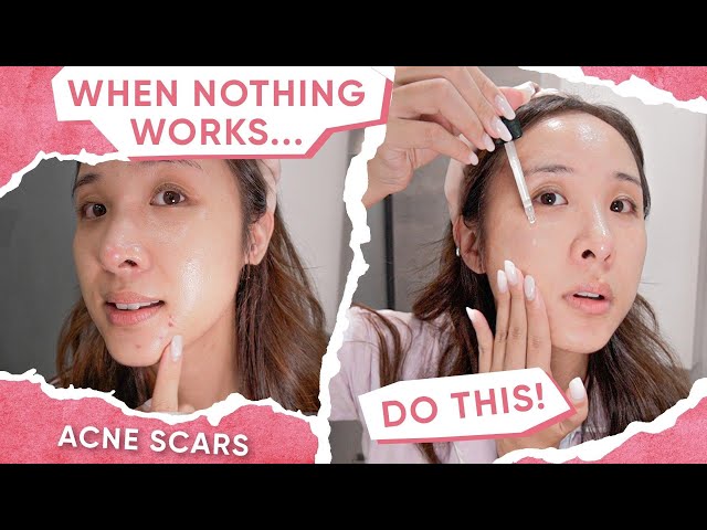 How to REALLY fade Dark Spots that AREN'T Fading (ft. Numbuzin)
