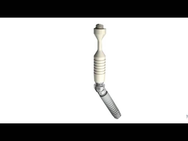 Ankylos™ SmartFix – Prosthetic solution on tilted implants | Dentsply Sirona