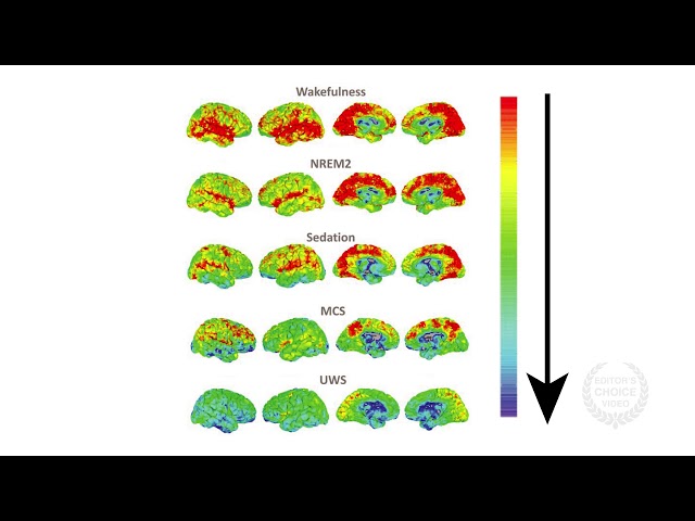 Disrupted global brain signal during unconsciousness