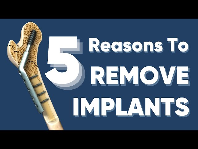 फ्रैक्चर ठीक होने के बाद क्या प्लेट/स्क्रू/रोड निकलना ज़रूरी है ?implant removal after fracture heals