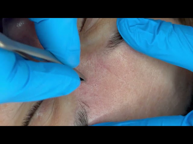 Oddly Satisfying Process of Brow Tweezing+UpperLip Waxing💆‍♀️💤