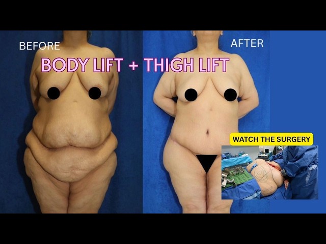 Full 360 Body Lift + Thigh Lift in ONE Surgery (Graphic, Real OR Footage)