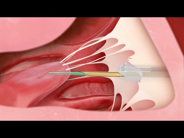 Transcatheter Mitral Valve Repair | Medical Animation