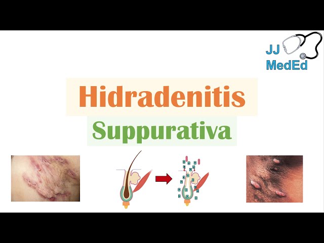 Hidradenitis Suppurativa (HS) | Pathophysiology, Triggers, Signs & Symptoms, Diagnosis, Treatment