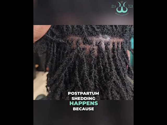 Postpartum Hair Shedding: What Happens & Solutions #shorts