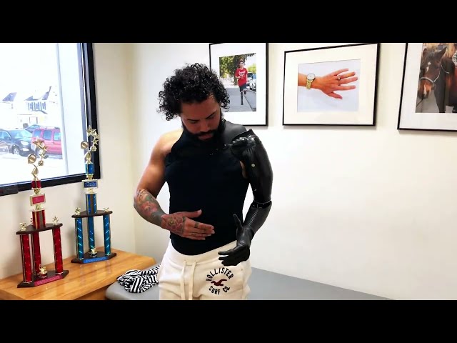 Above Elbow Amputee Puts on Myoelectric Prosthetic Arm