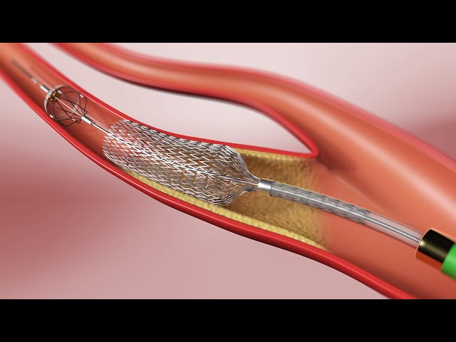 Carotid Angioplasty and Stenting (3D Animation)