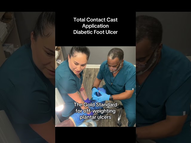 Total Contact Cast #podiatry #woundcare #limbpreservation #limbsalvage