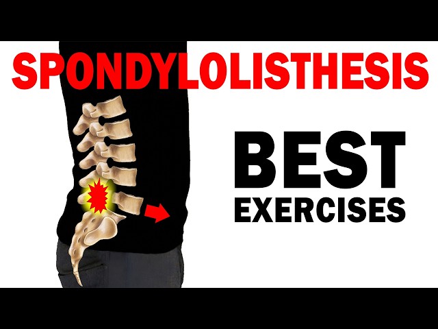 Best Spondylolisthesis Exercises for RELIEF (& what to avoid)