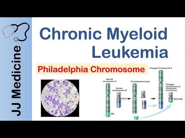 Chronic Myeloid Leukemia (CML) | Pathogenesis, Symptoms and Treatment