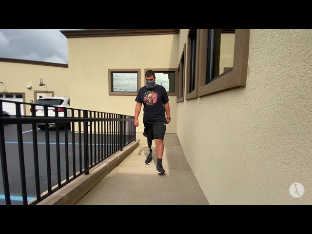 An above knee amputee using his prosthetics, showing great progress!
