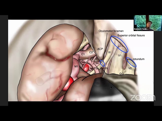 Unlock the Cavernous Sinus and Behold the Posterior Circulation Aneurysms- Rokuya Tanikawa