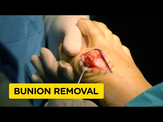 How Bunions Are Removed (Bunionectomy Surgery Animation)