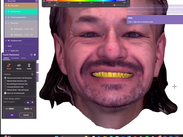 Digital denture workflows explained