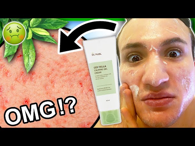 I tried the iUNIK Centella Calming Gel Cream for ONE WEEK! || Review (best moisturizer for acne?)