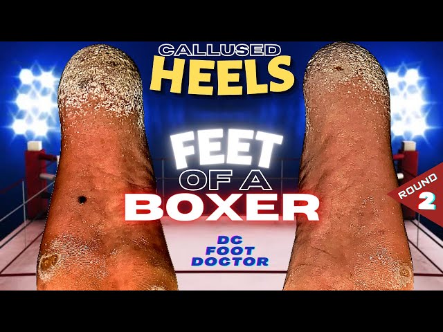 Feet of a Boxer: Knocking Out Painful Calluses, Round 2: The Heels