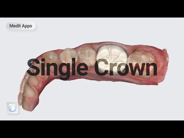 Designing a Single Crown with the Medit ClinicCAD App
