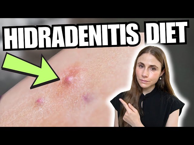 Hidradenitis Suppurativa and Diet: What the Science Really Says