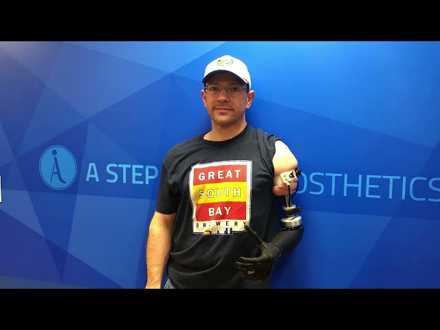 Upper Extremity Amputee with Osseointegration | Limb Replacement with Titanium implant