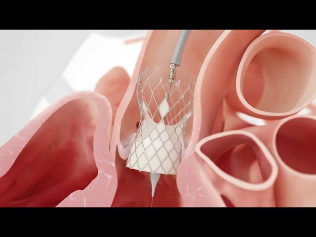 TAVI for aortic stenosis | Medical animation
